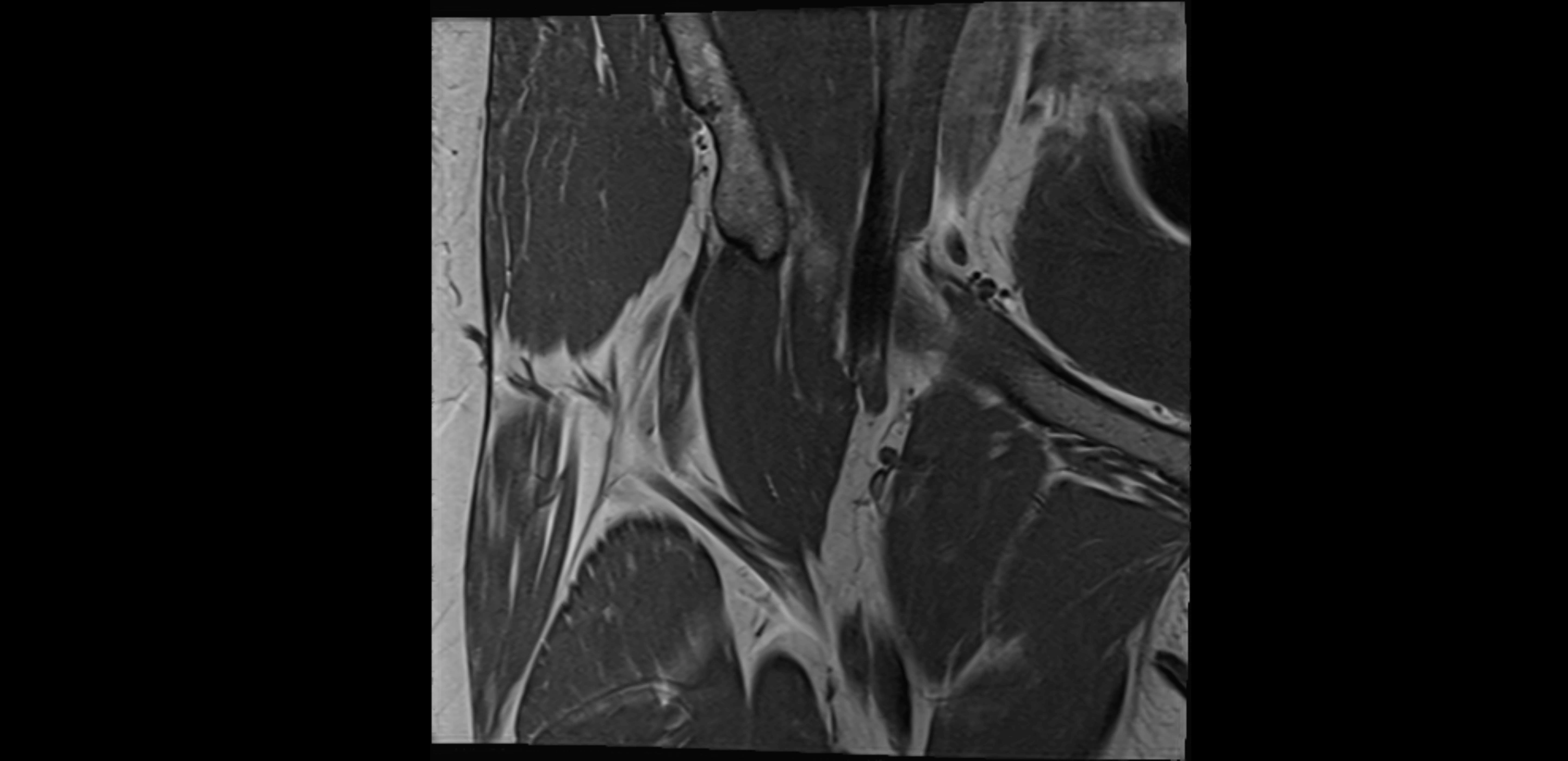 MRI Hip ligaments coronal cross sectional anatomy 3T  radiology  image-img-00001-00001.webp